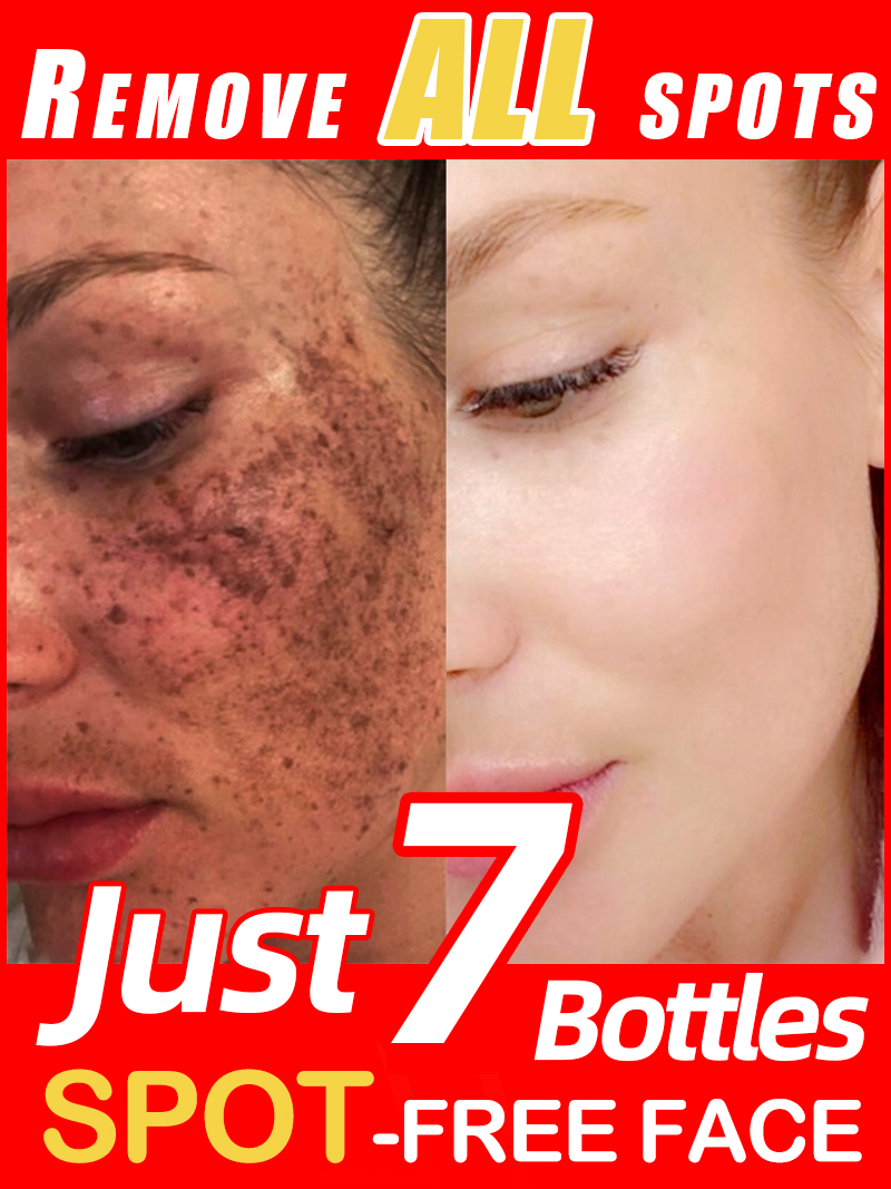 Skincare Luxury Whitening - Ilumina las pecas Melasma, las manchas